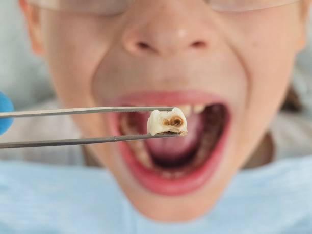Best Emergency Treatment for Dental Infections or Abscesses in Cohoes, NY